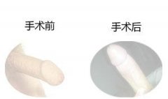 包茎会不会影响生育