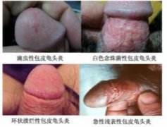 龟头炎的危害有哪些？