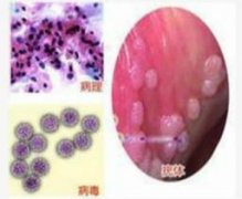 宿迁第二医院治阴茎长红点效果好